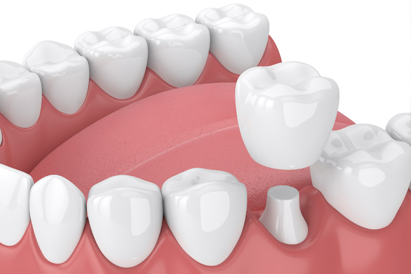 Dental Crowns in Waxhaw