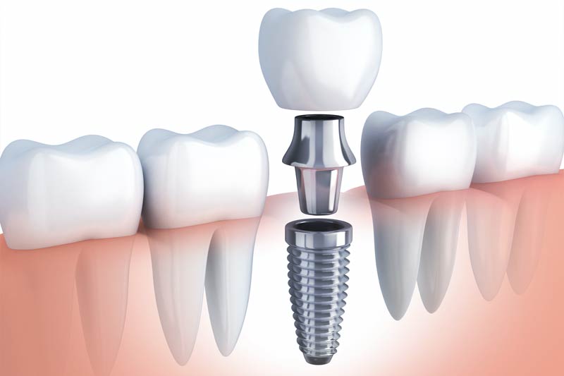 Implants Dentist in Waxhaw