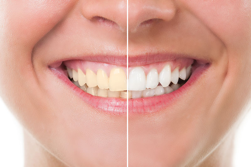 Teeth Whitening in Waxhaw
